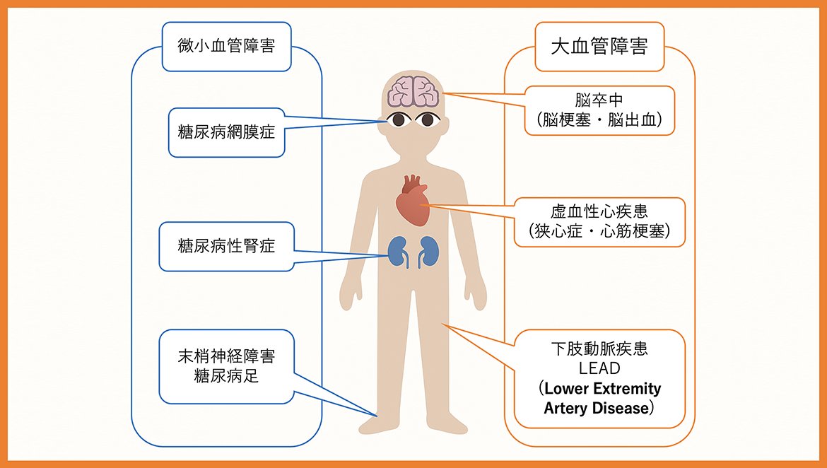 糖尿病から起こる合併症とそのリスク 
