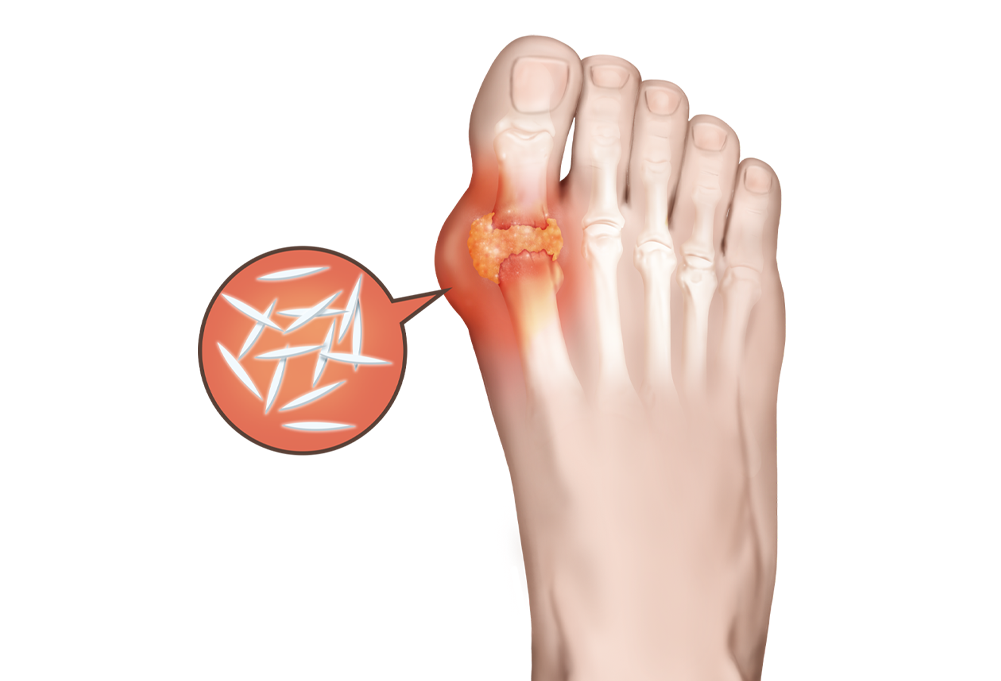 脂質異常症（高脂血症）とは