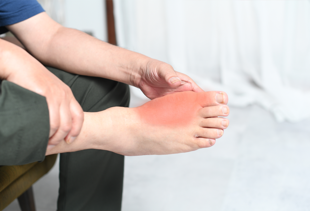 高尿酸血症・痛風について