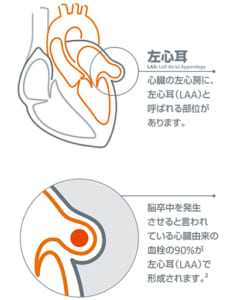 心房細動において脳梗塞が起きる機序