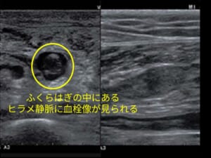 ふくらはぎの中にあるヒラメ静脈の血栓像