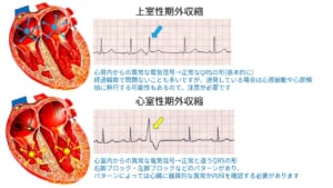 上室性期外収縮と心室性期外収縮
