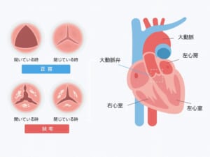大動脈弁狭窄症のイラストです。大動脈弁に開放制限が生じます。