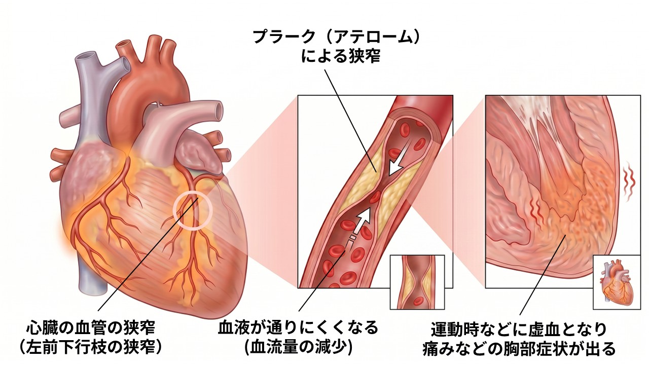 狭心症で冠動脈が狭くなり、心筋への血流が不足する仕組みを示した説明画像