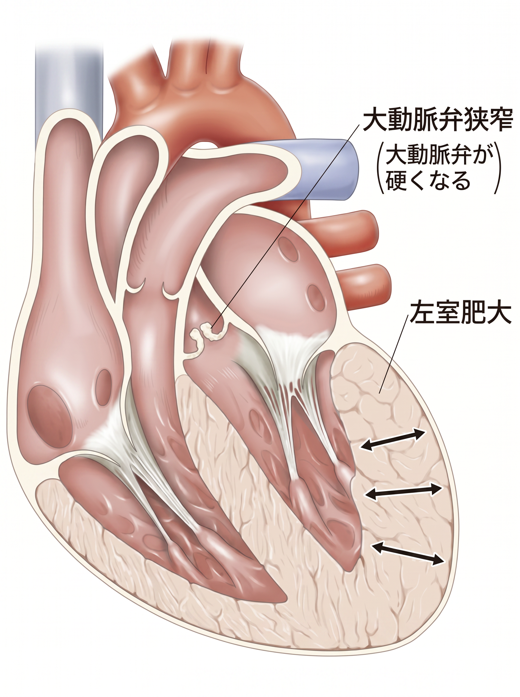 大動脈弁狭窄症のイラスト
