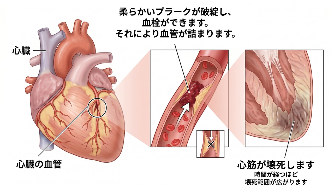 心筋梗塞で冠動脈が詰まり、心筋が壊死する仕組みを示したイラスト