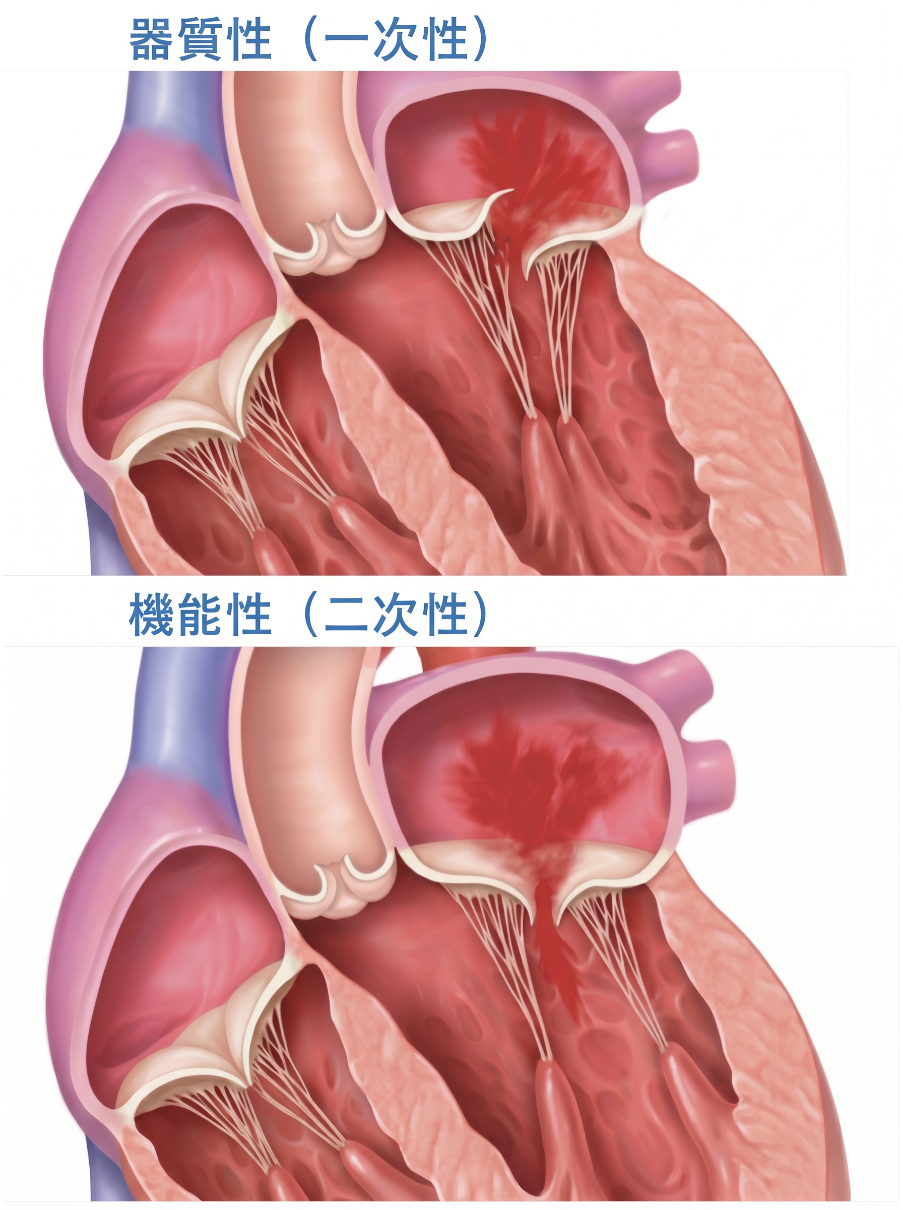 僧帽弁閉鎖不全症のイラスト