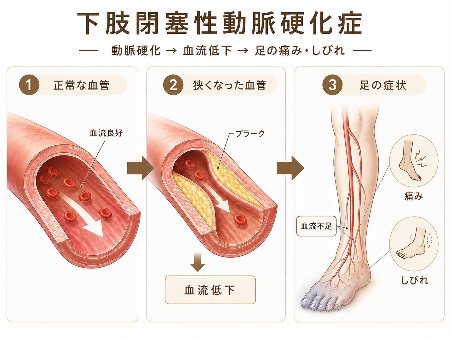 動脈硬化により血管が狭くなり、血流が低下して足の痛みやしびれが起こる仕組み