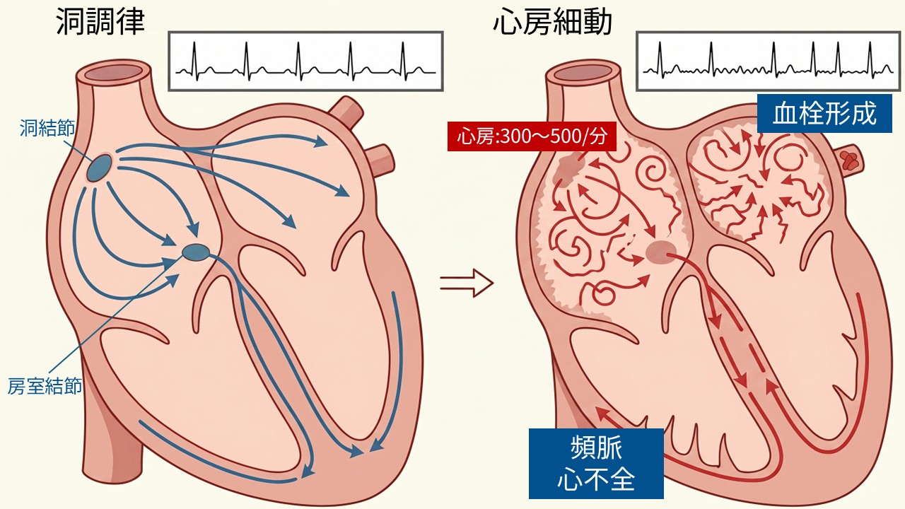 心房細動では心房の電気信号が乱れ、脈が不規則になることを示した説明図