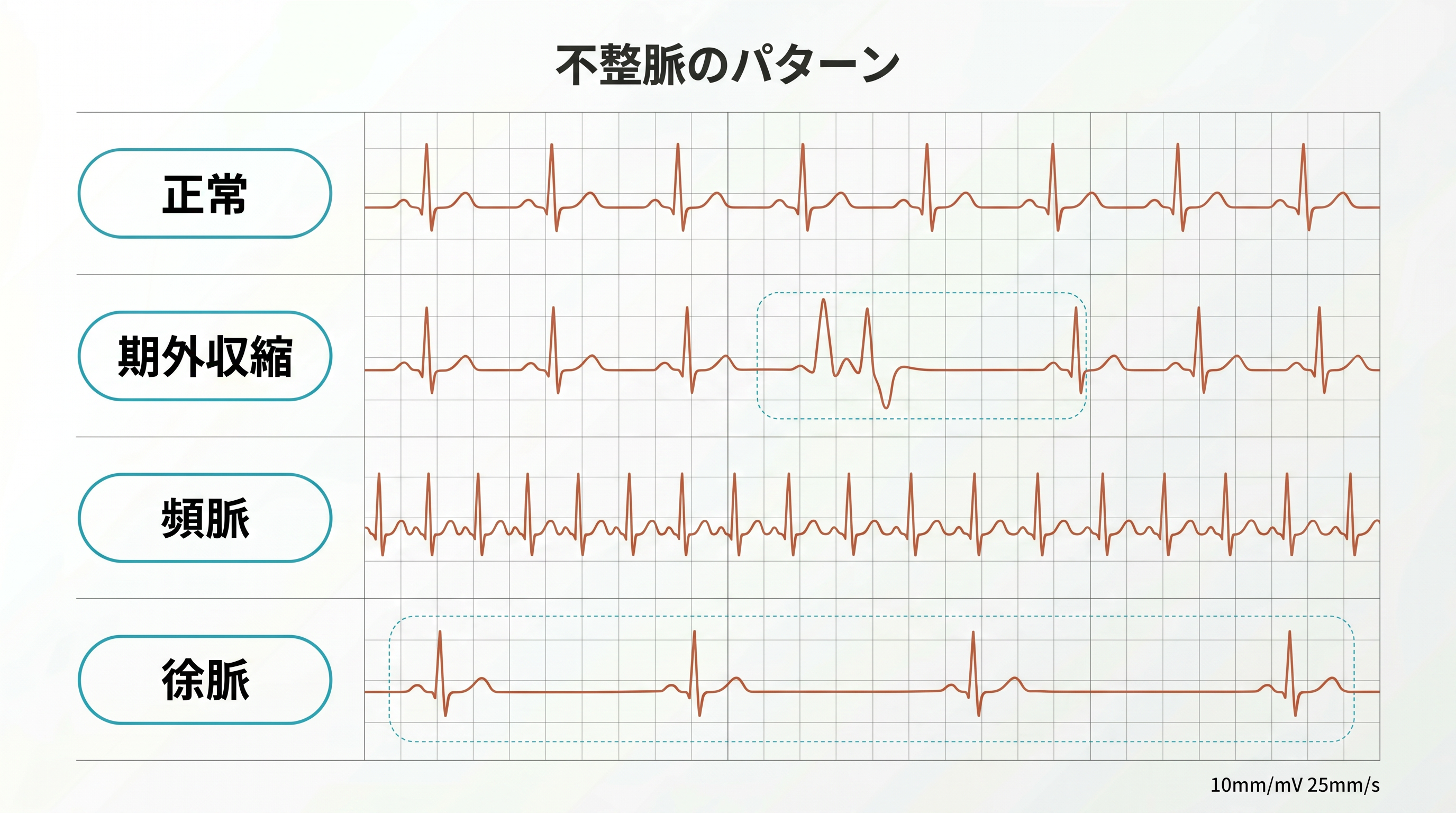 不整脈の心電図パターンを示した説明図