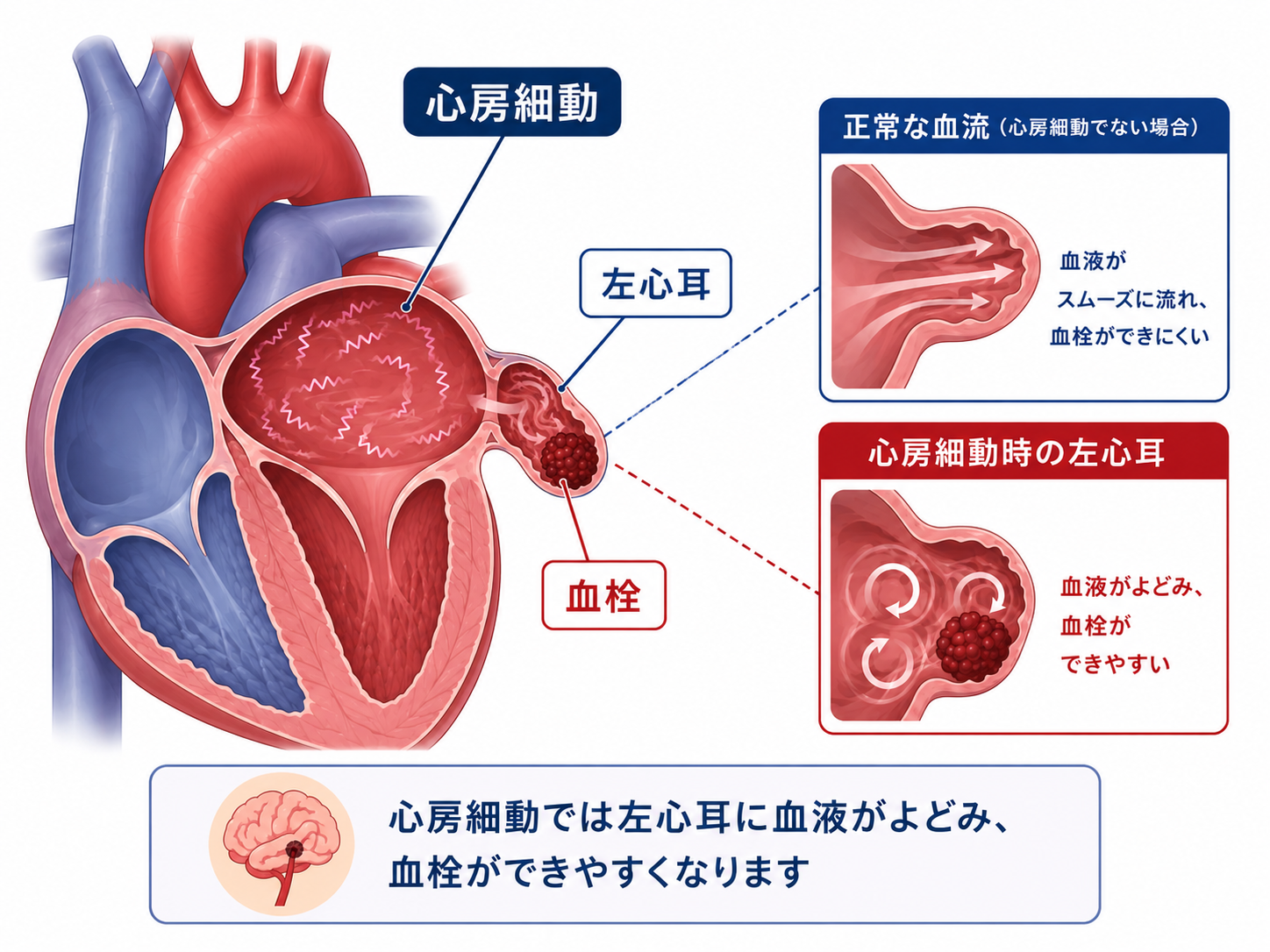 心房細動の時に左心耳に血栓ができる仕組みの説明図