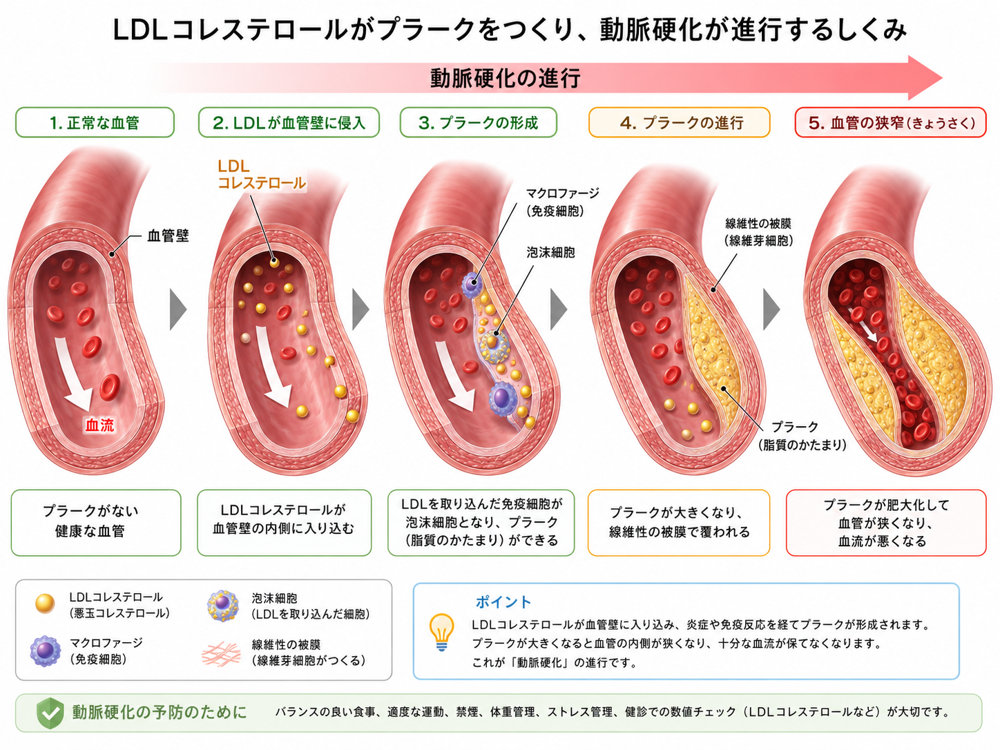 LDLコレステロールが血管壁にプラークを作り動脈硬化が進むイメージ図